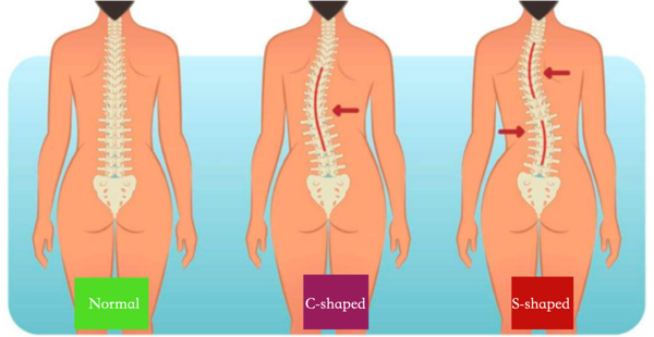 C and S forms of scoliosis
