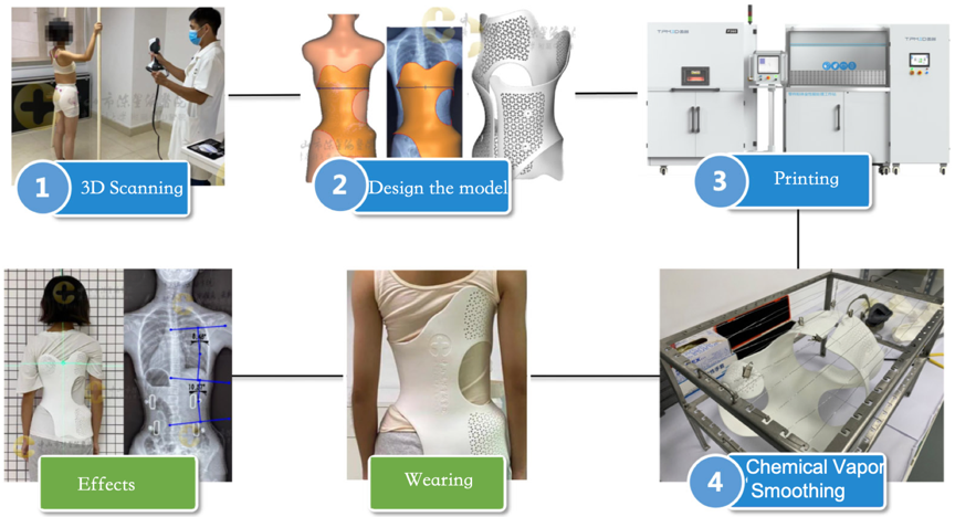 manufacturing process of 3d printing scoliosis orthosis
