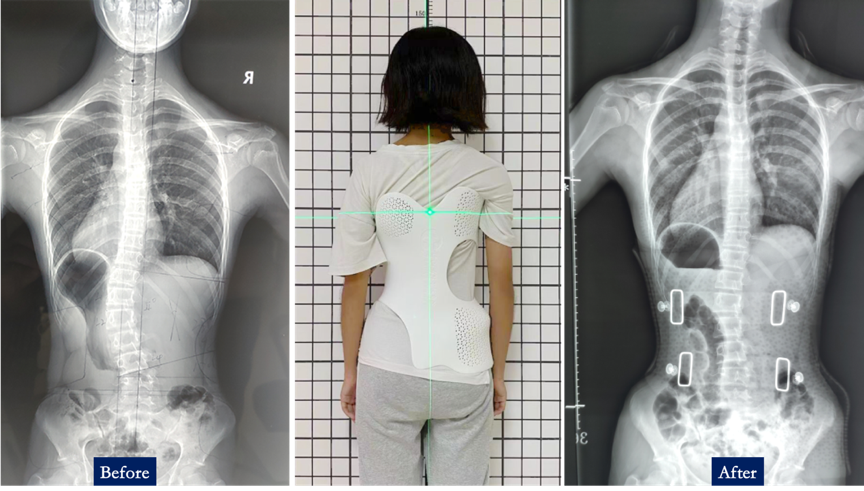 radiographs of patients before and after wearing 3d printed orthosis