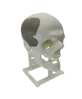 Cranioplasty model