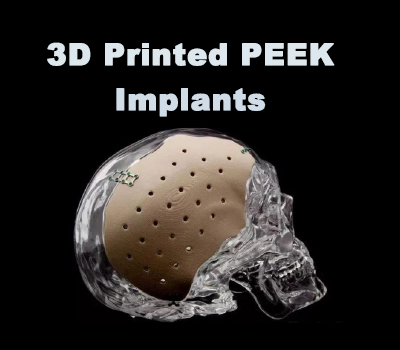 3D printed PEEK for implant applications