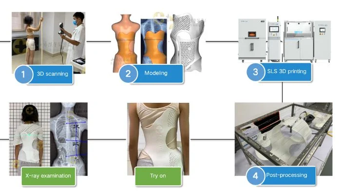SLS 3D printing greatly simplifies the process for making braces for scoliosis, as can be seen in this image