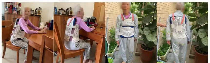 3D 프린팅된 흉곽 지지대