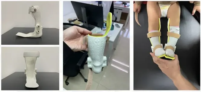 발목 발 보조기