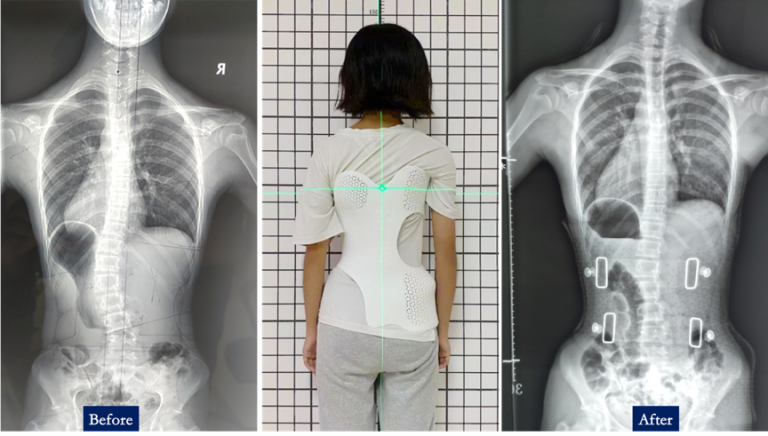 How a 13-Year-Old Girl Benefits from Personalized SLS 3D-Printed Scoliosis Orthosis