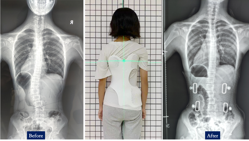 How a 13-Year-Old Girl Benefits from Personalized SLS 3D-Printed Scoliosis Orthosis