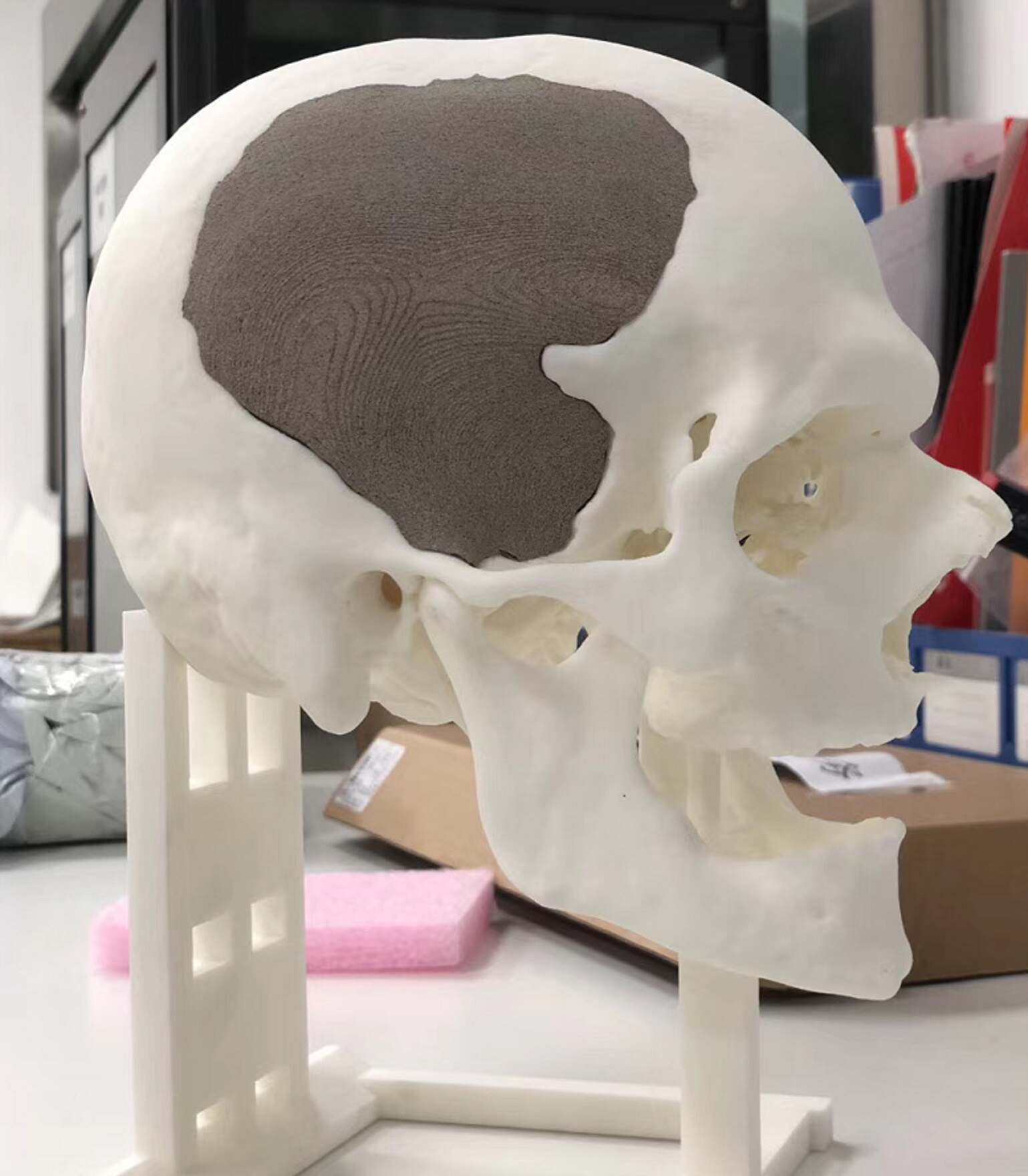 3D printed skull repair with TPM3D Peek IND material