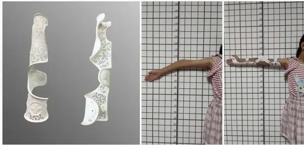 3D printed Elbow Orthosis