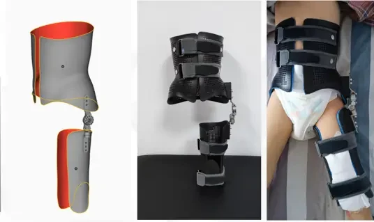 3D printed Hip Orthosis