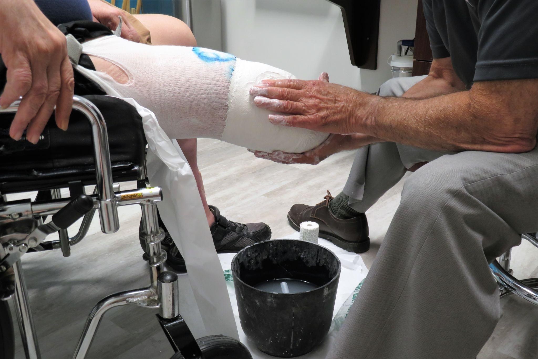 Prosthetist molding an amputated limb