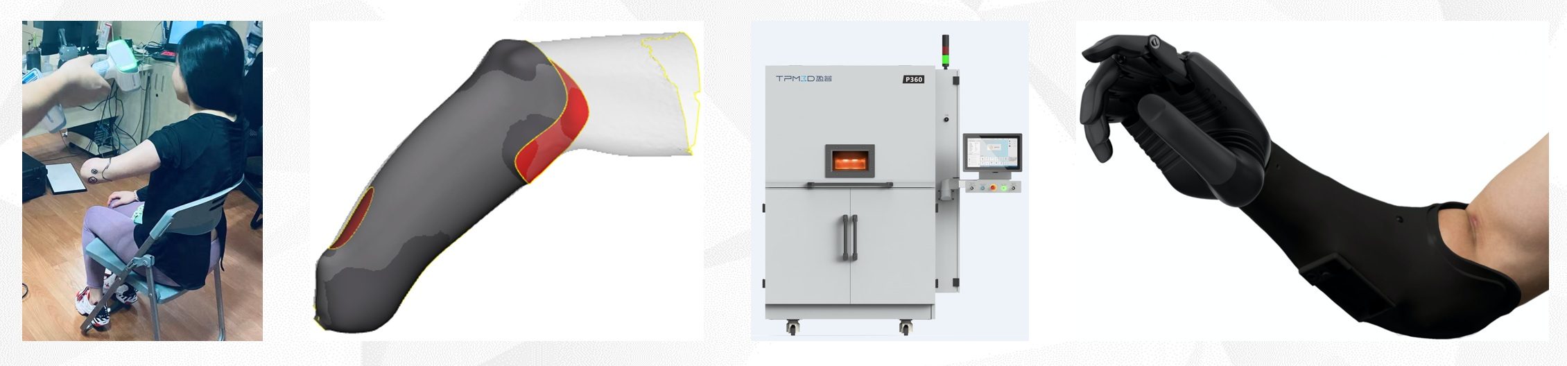 From 3D Scanning to 3D Printed Prosthetics