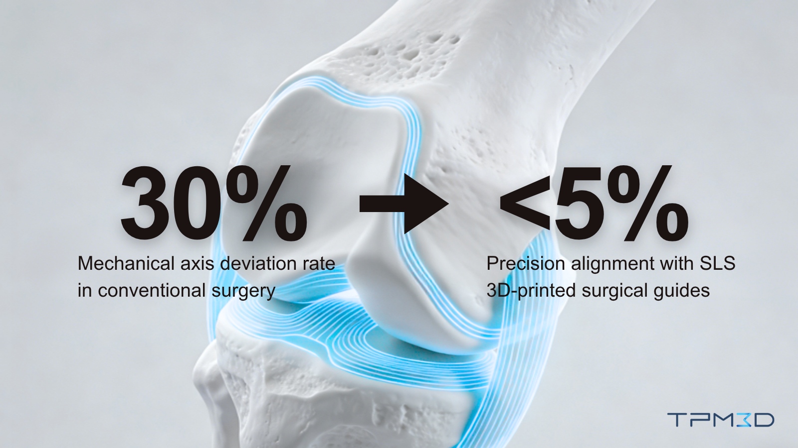 SLS surgical guide ensuring precise implant alignment in orthopedic procedure